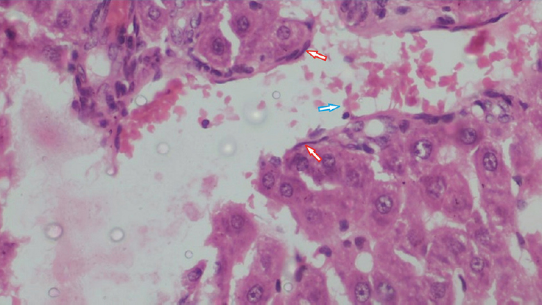 Left renal biopsy showing the renal cortical cells with several aseptate fungal hyphae (red arrow) with dense inflammatory infiltrates comprising mainly neutrophils (blue arrow) (H&E stain; ×100).